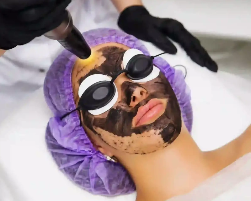 Carbon Peeling 3