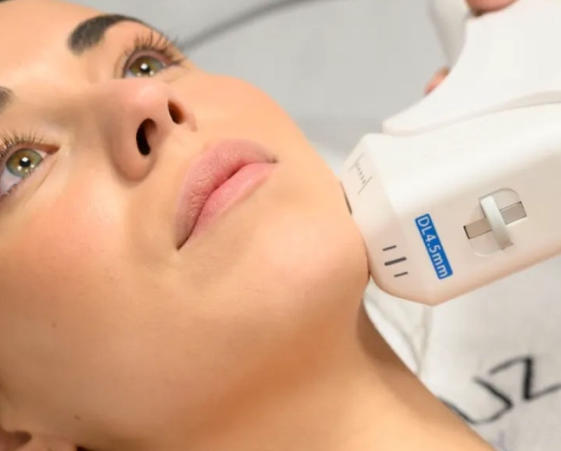 HiFu Facial 2