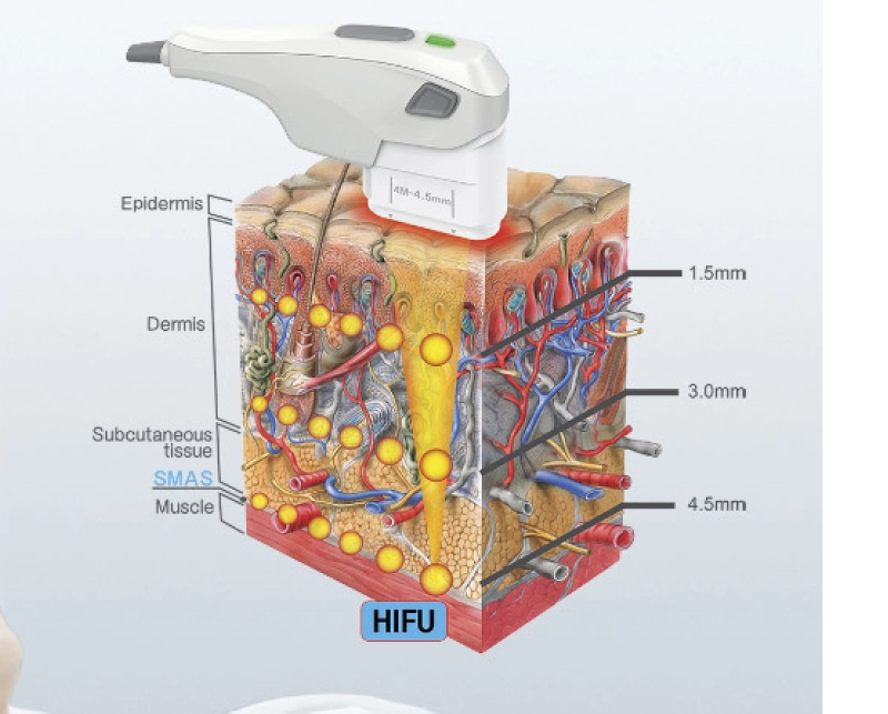 HiFu Facial 5