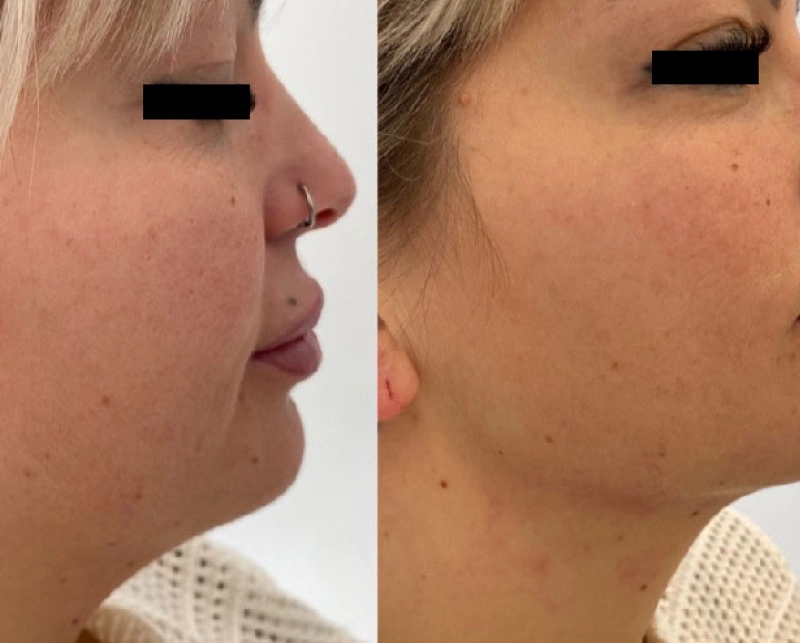 HiFu Facial 8