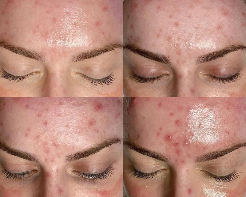 Hydrafacial 2